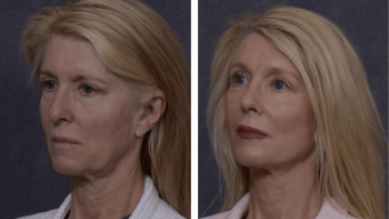 Professional Facelift Surgery in Sydney Performed by Dr. Hodgkinson!