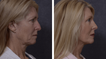 Professional Facelift Surgery in Sydney Performed by Dr. Hodgkinson!