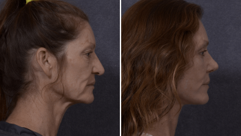 Professional Facelift Surgery in Sydney Performed by Dr. Hodgkinson!