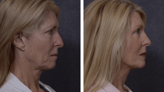 Professional Facelift Surgery in Sydney Performed by Dr. Hodgkinson!