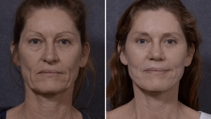 Professional Facelift Surgery in Sydney Performed by Dr. Hodgkinson!