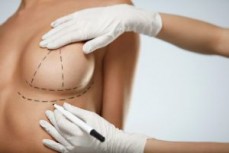 Professional Breast Lift Surgery in Sydney By Breast & Body Clinic - Visit Us Today!