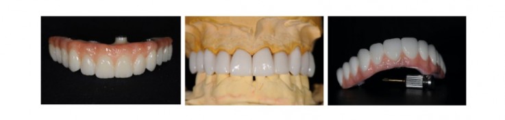 Dentures Melbourne