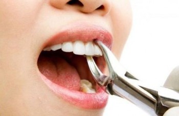 Affordable Tooth Extraction in Burnside - Parkwood Green Dental