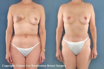 Best Breast Reconstruction Surgeons in Sydney - Book A Medical Consultation Today!
