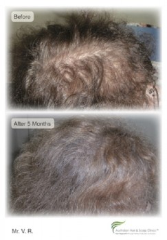 Looking for the Best Hair Loss Treatment in Sydney?