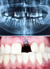  Best Dental implants Melbourne | Prahran Family Dental