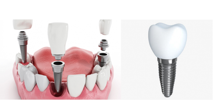  Best Dental implants Melbourne | Prahran Family Dental