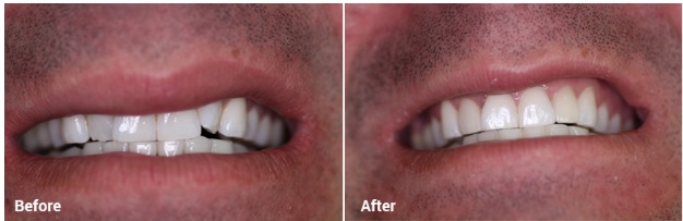 Get best porcelain veneers in Melbourne | Prahran Family Dental