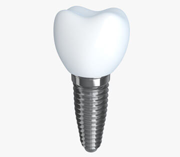 Get Best teeth implants in Melbourne | Prahran Family Dental