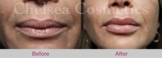 10% Off Dermal Fillers in Melbourne - Hurry and Visit Us Now!!