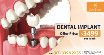 Dental Implant Carina Brisbane - Care 4 Teeth