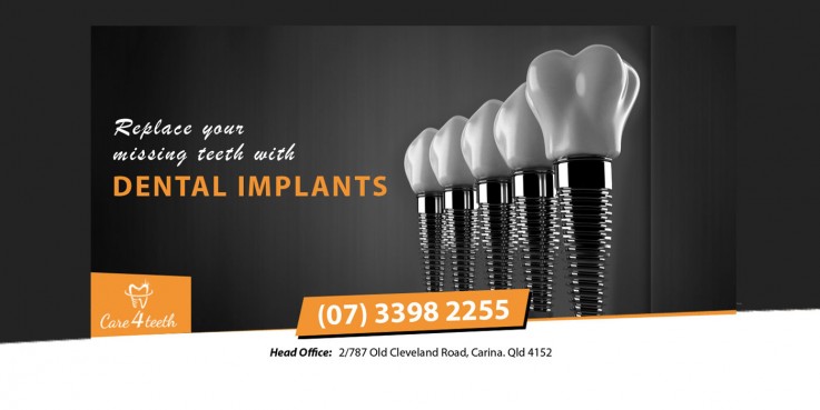 Dental Implant Carina Brisbane - Care 4 Teeth