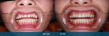 Everything You Need to Know About Porcelain Dental Veneers Services