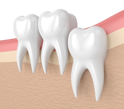 Everything You Need to Know About Porcelain Dental Veneers Services