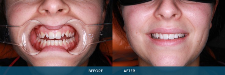Everything You Need to Know About Porcelain Dental Veneers Services