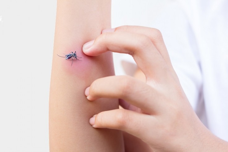 Bothered About Mosquito Bites? Follow These Tips for Quick Relief