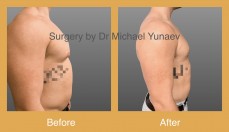  Professional Male Breast Reduction Surgery in Sydney - Contact Us Now!
