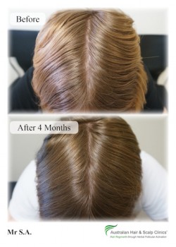 Take Control of your Hair&rsquo;s Heath With Hair Loss Clinic in Malvern