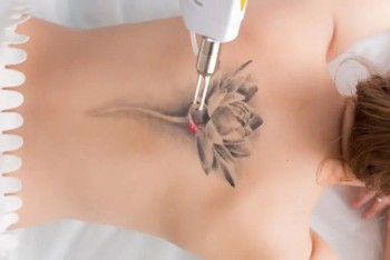Find the Best Tattoo Removal in Sydney