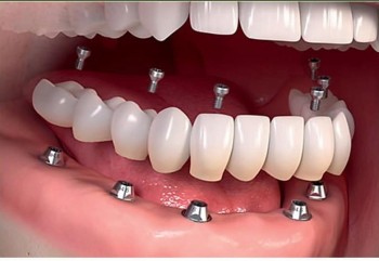 gum disease clinic in vizag manohar dental 