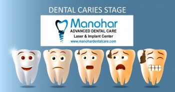 fractured teeth correction clinic in vizag manohar dental 