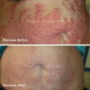 Best Eczema Cream, Diet | Steroid Free Eczema Treatments for Babies, Kids, Face, Hands in Melbourne