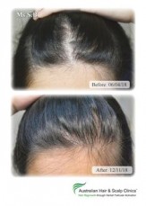 Searching for a Natural Hair Regrowth Treatment in Brisbane?