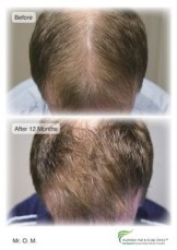Searching for a Natural Hair Regrowth Treatment in Brisbane?