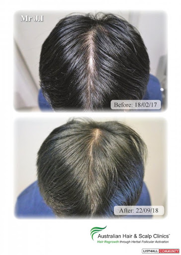Opt for our hair loss treatment in Canberra today