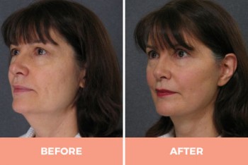 High-Quality Lower Face Lift Surgery in Sydney -  Contact Dr Hodgkinson Today!