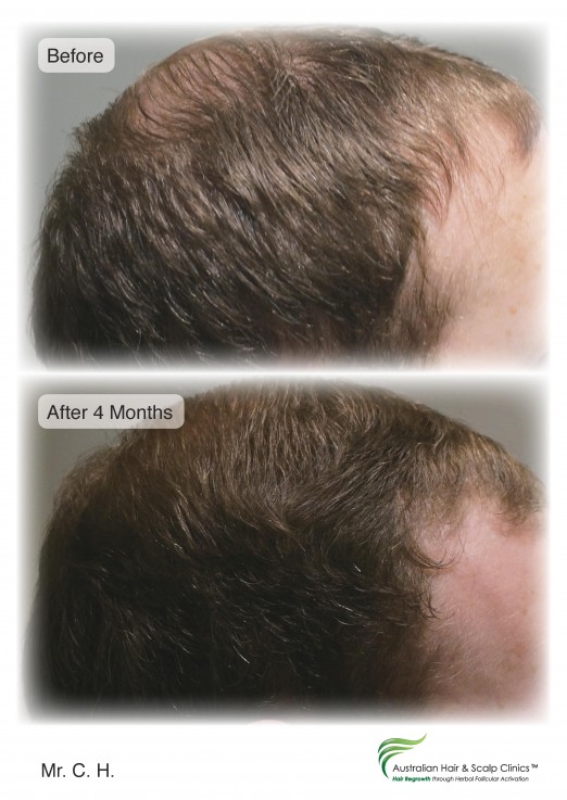 Fall in Love with Our Hair Loss Treatment in Gold Coast