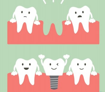 Dental Implants- My Gentle Dentist
