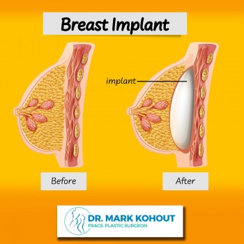 Breast Revision Surgery Sydney