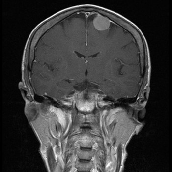 Worried about Tumour Surgery in Melbourne? Get in Touch with the Best!