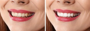 Searching for Teeth Whitening Treatment in Brunswick