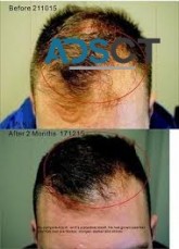 Hair Treatment in Brisbane