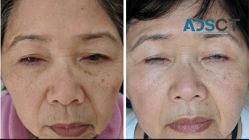 Top Wrinkle Removal Treatment Beauty Salon In Melbourne