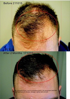 Herbal Treatment for Hair Loss in Gold Coast : No side Effects