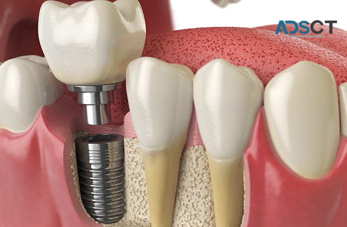 Replace Your Missing Teeth With Dental Implants