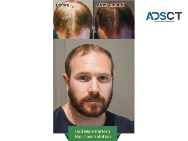 Say Goodbye to Hair Fall with Hair Loss Treatment in Canberra