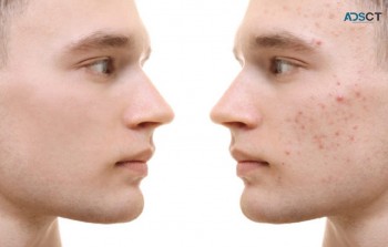 Acne Treatment in Coogee