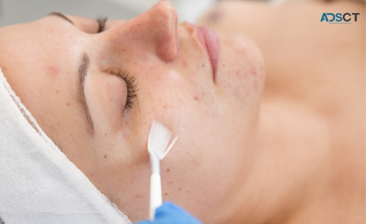 Cosmedix Benefit Peel Treatment 