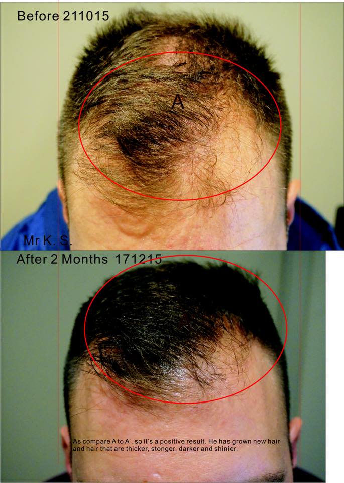 Male Pattern Hair Loss Treatment in Sydney: Enquire Now