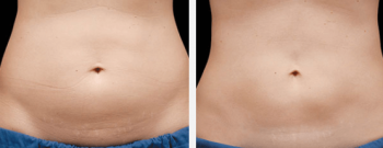 Highly Effective Coolsculpting In Melbourne - Enquire Now!