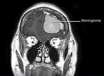 Looking For Meningioma Surgery in Melbourne?