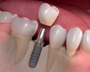 Affordable dental implants in flemington