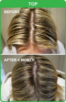 Most Trusted Hair Loss Treatment in Adelaide