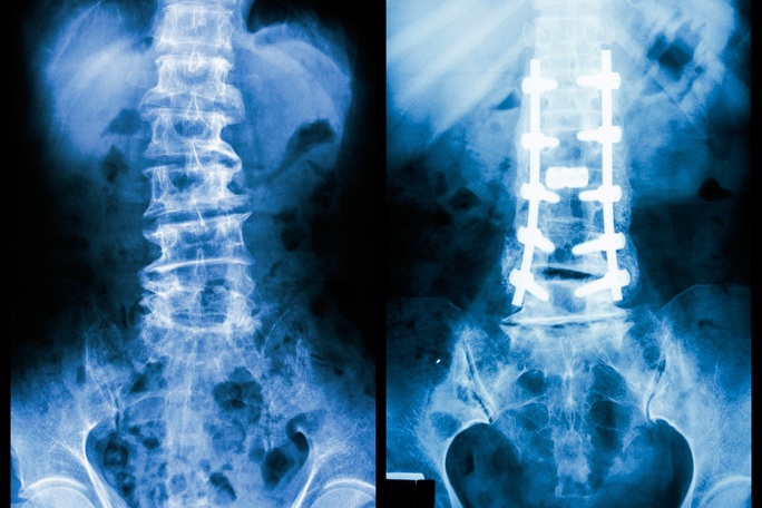 Complex Spine Surgery by an Experienced and Expert Surgeon