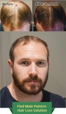 Natural and Herbal Hair Loss Treatment in Sydney